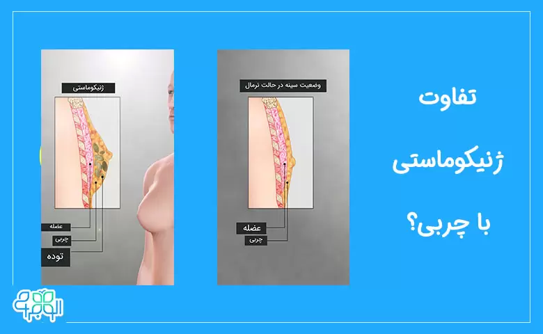 تفاوت ژنیکوماستی و چربی
