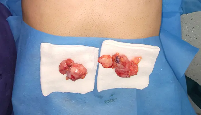 غده ژنیکوماستی