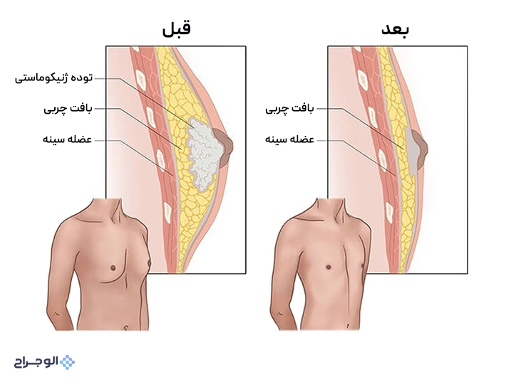 خارج‌سازی توده ژنیکوماستی با جراحی