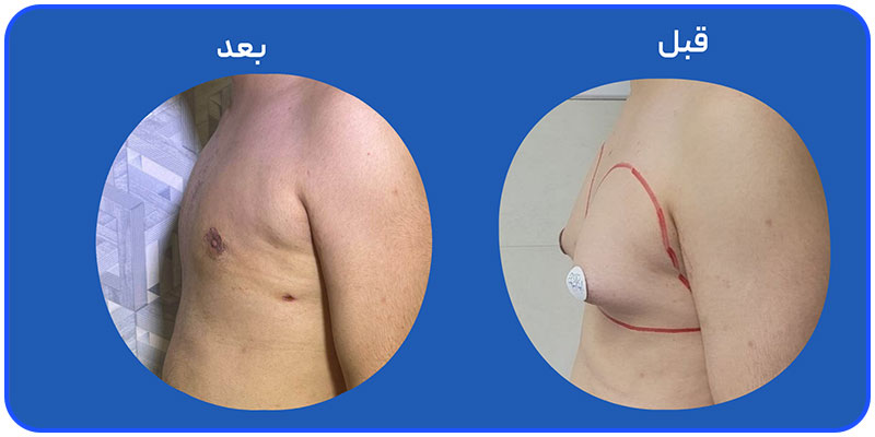 عمل جراحی ژنیکوماستی