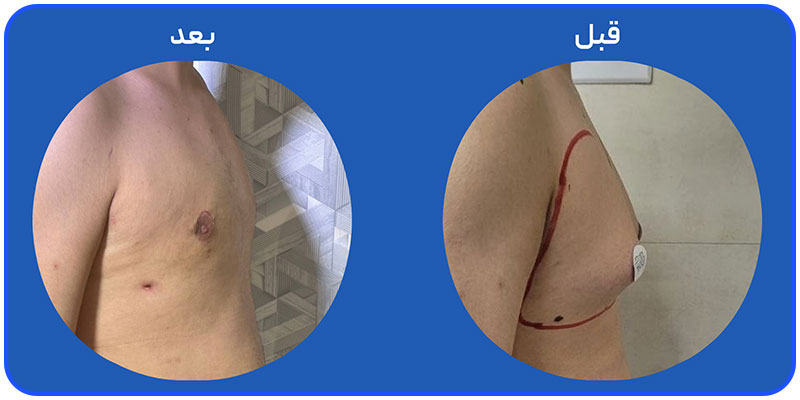 درمان قطعی ژنیکوماستی با جراحی