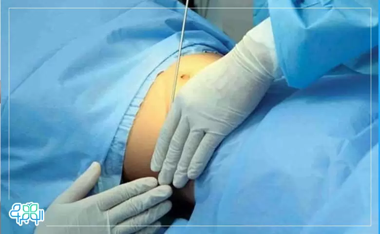 فرق لیپوماتیک با لیپوساکشن ]چیست