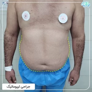 عمل لیپوماتیک شکم مردان