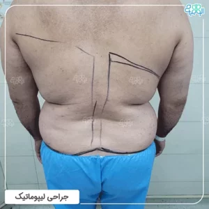 جراحی لیپوماتیک پهلو آقایان