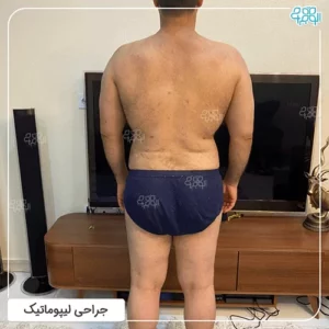 روش لیپوماتیک برای مردان