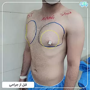 ژنیکوماستی کاذب چگونه است؟