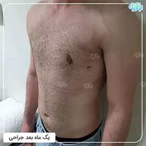 ژنیکوماستی-کاذب و درمان آن