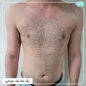 ژنیکوماستی-کاذب چیست؟