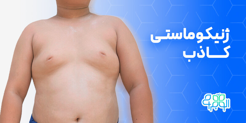 ژنیکوماستی کاذب چیست؟