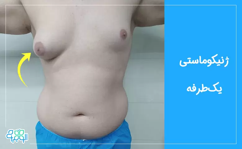 ژنیکوماستی یک طرفه
