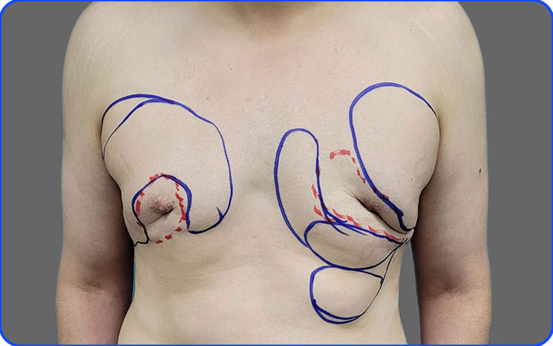 عکس ناموفق عمل ژنیکوماستی