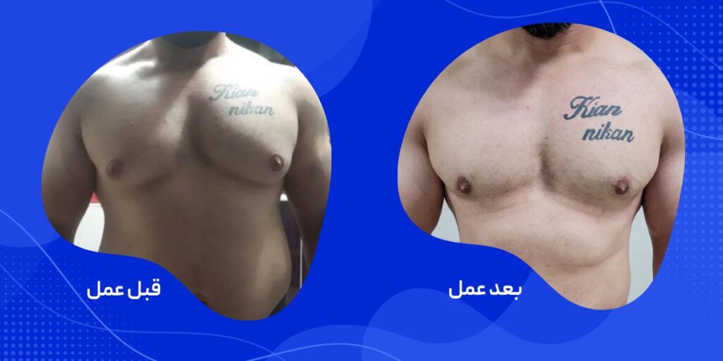 عمل ژنیکوماستی در ورزشکاران