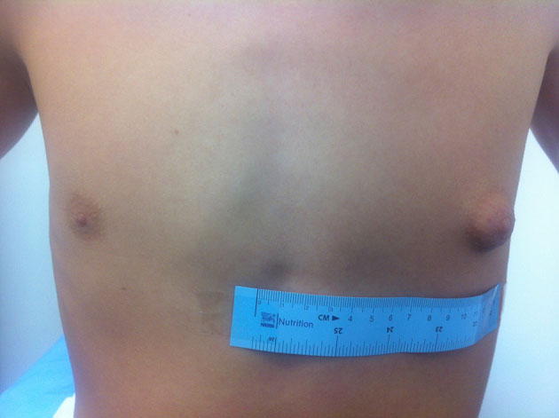 بیماری ژنیکوماستی خفیف