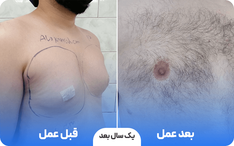 جای اسکار ژنیکوماستی 