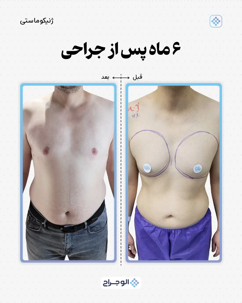 ۶ ماه بعد از جراحی در الو جراح