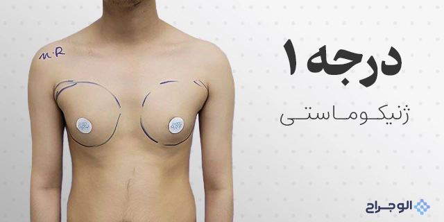 درجه یک ژنیکوماستی در الو جراح