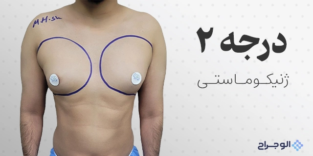 درجه دو ژنیکوماستی در الو جراح
