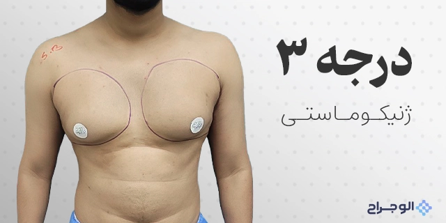 درجه سه ژنیکوماستی در الو جراح