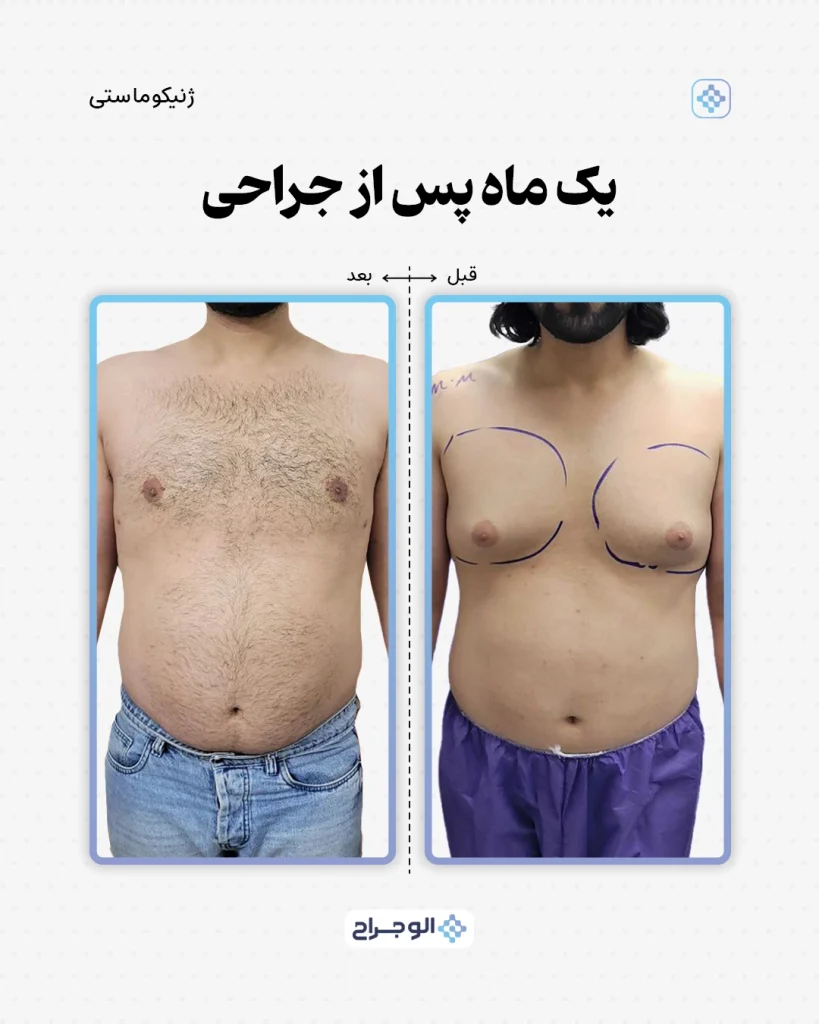 ۱ ماه بعد از جراحی در الو جراح