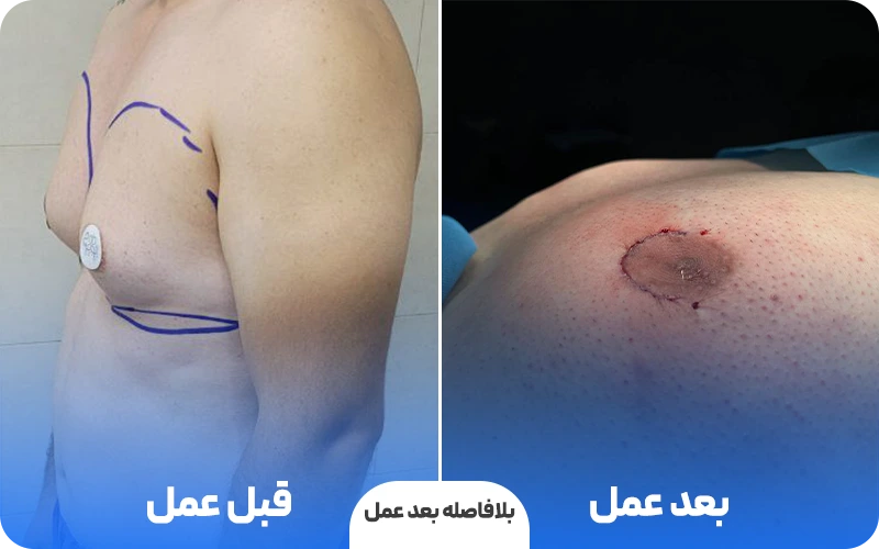 قبل و بعد عمل ژنیکوماستی در الو جراح