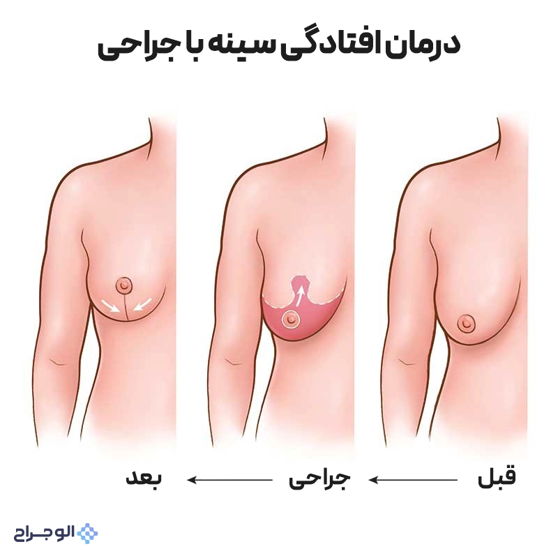 درمان افتادگی سینه با جراحی